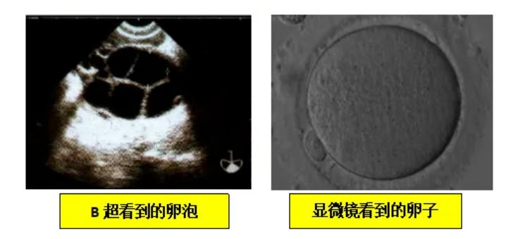 试管婴儿备孕中，卵泡数、取卵数、胚胎数层层缩水，备用方案在哪？
